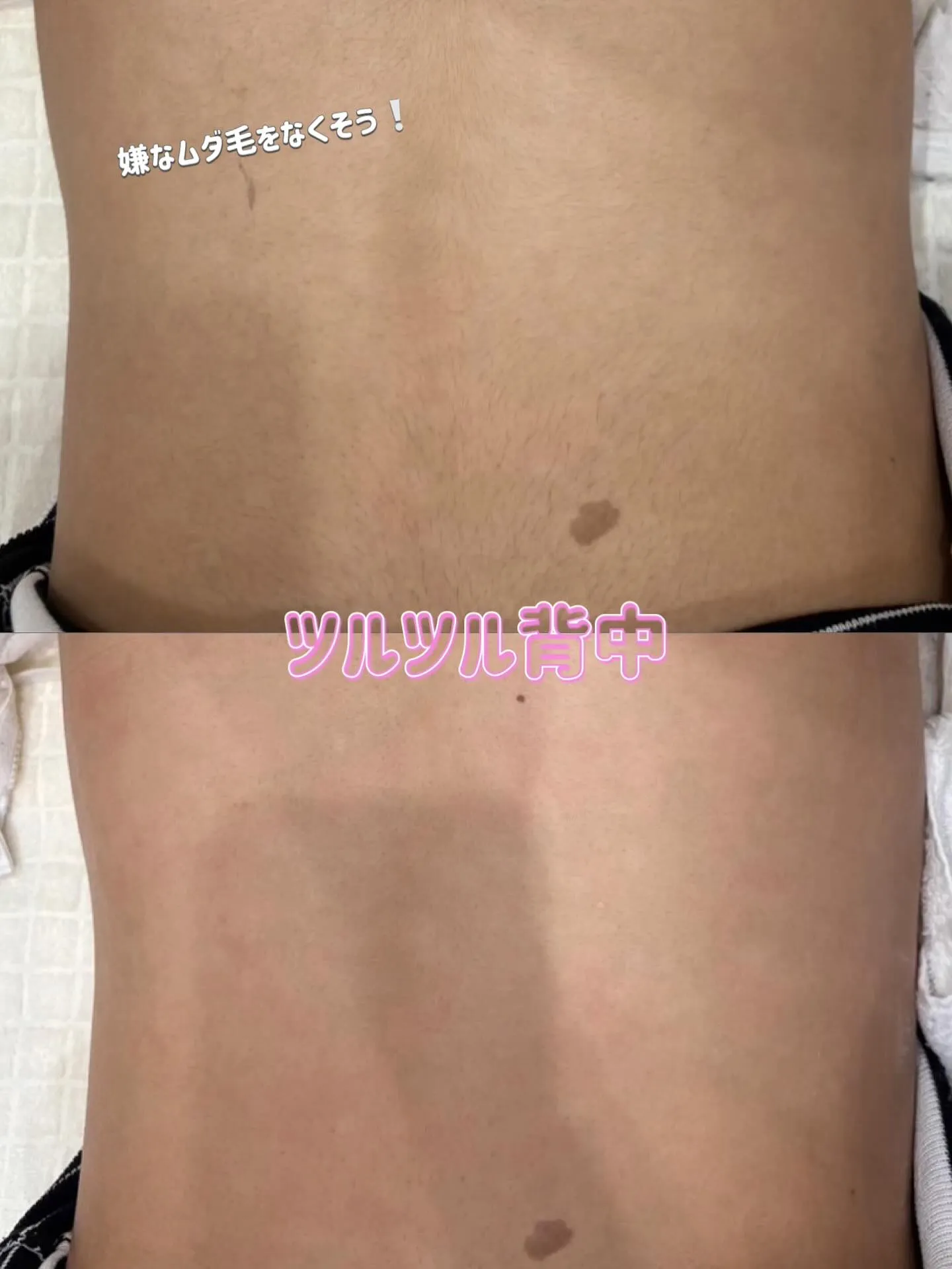 ツルツル背中を目指せ✊🏻 ̖́-︎💕︎︎